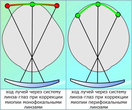 перифокальные линзы для очков